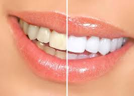 CocoBright™ Whitening Strips